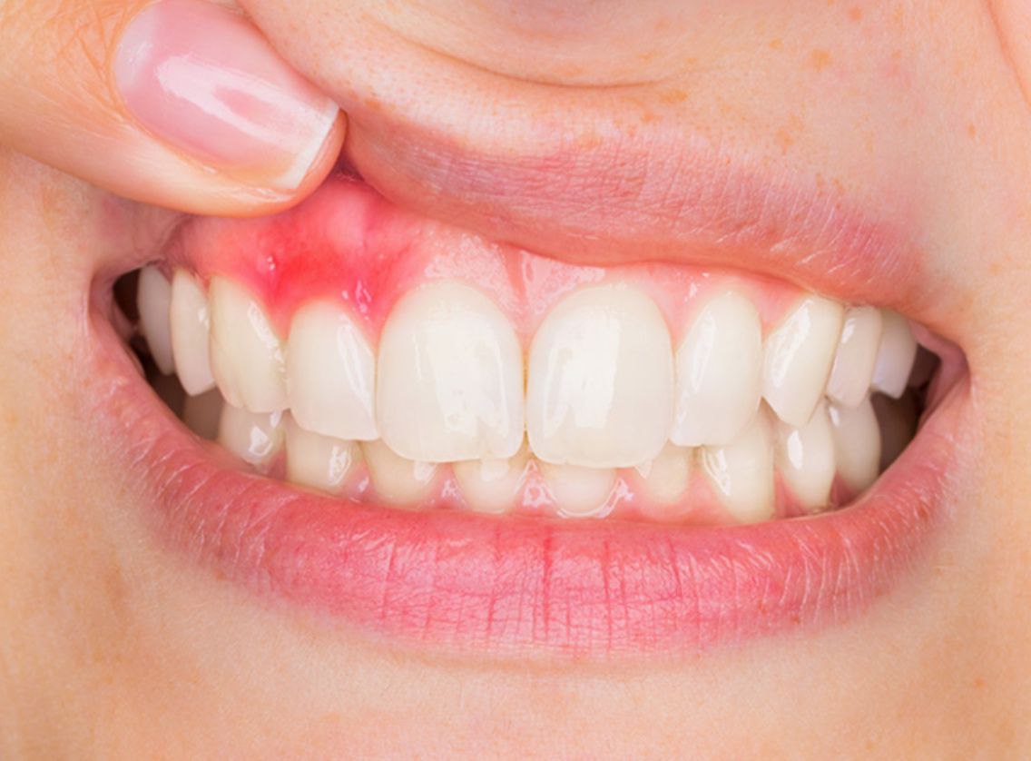 Осмотр десен и профилактика воспаления