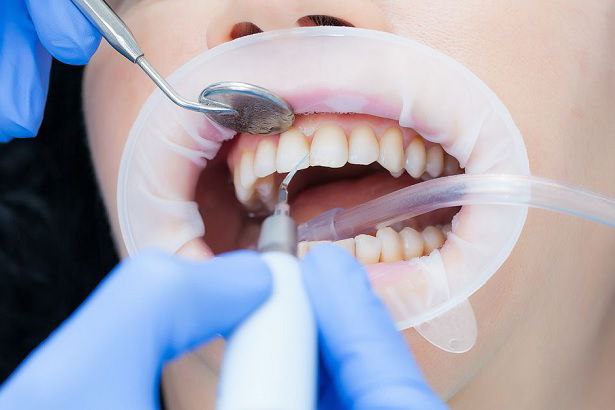 Профессиональная гигиена зубов